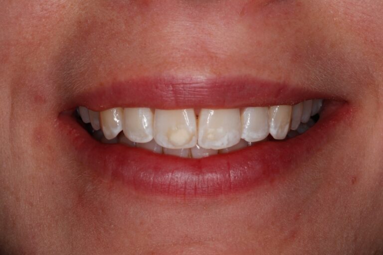 Patient's bite before orthodontic treatment (example 10)