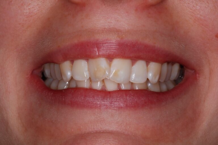 Patient's bite after clear aligner treatment (example 10)