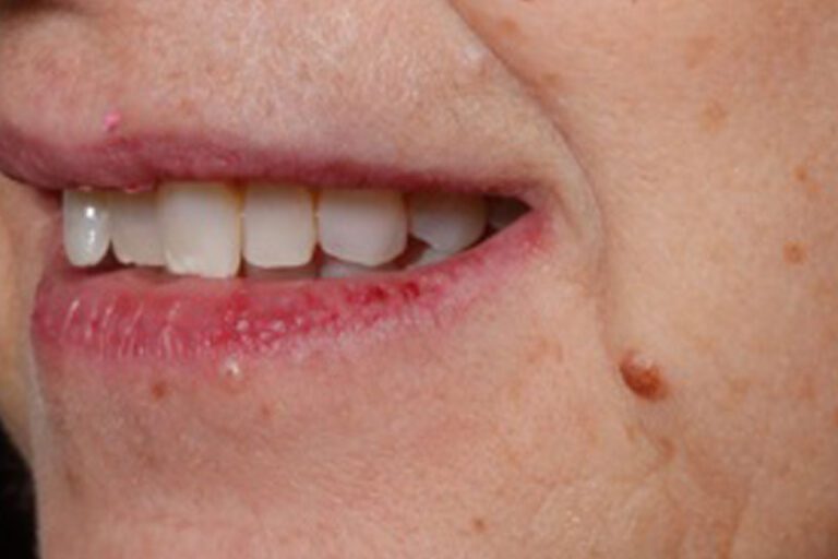 Patient's bite before orthodontic treatment (example 11)