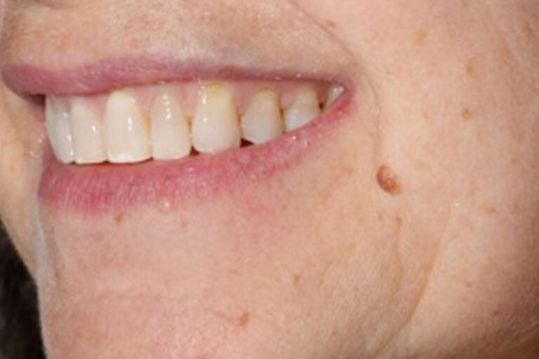 Patient's bite after clear aligner treatment (example 11)
