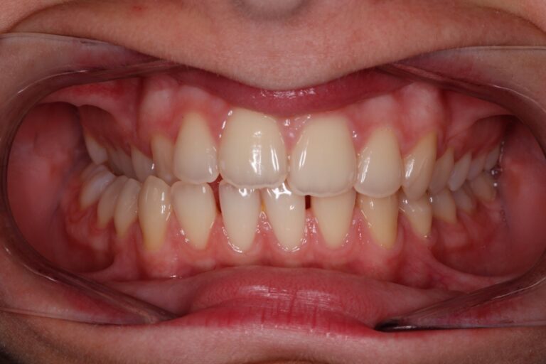 Patient's bite before orthodontic treatment (example 12)