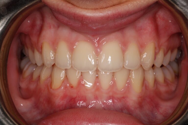 Patient's bite after clear aligner treatment (example 12)