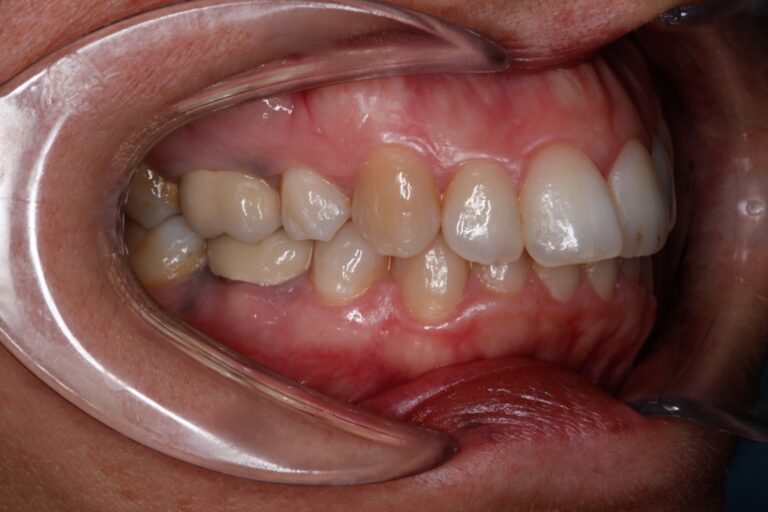 Patient's bite before orthodontic treatment (example 13)