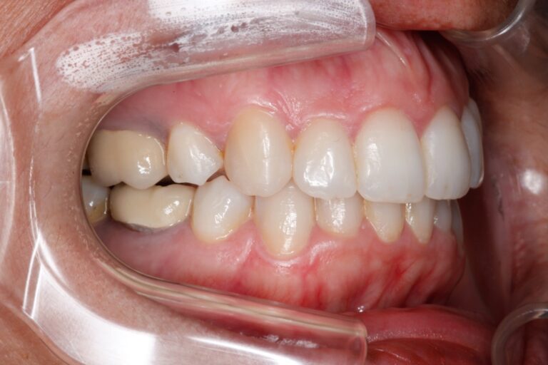 Patient's bite after clear aligner treatment (example 13)