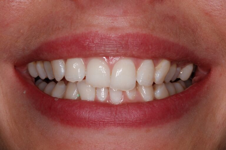 Patient's bite before orthodontic treatment (example 14)