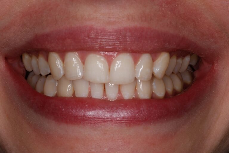 Patient's bite after clear aligner treatment (example 14)