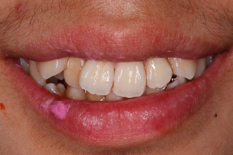 Patient's bite before orthodontic treatment (example 15)