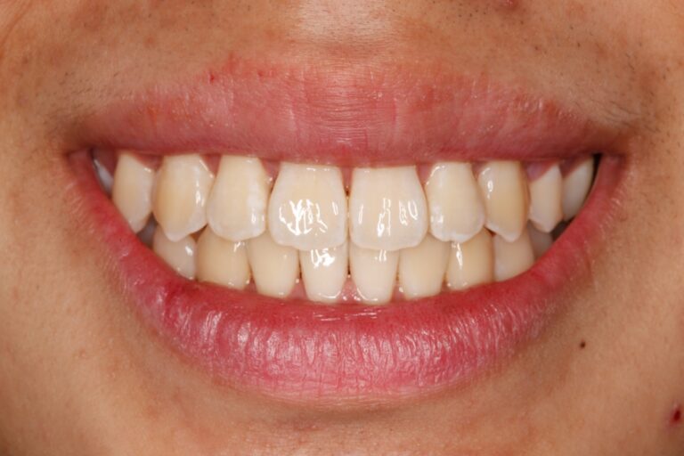 Patient's bite after clear aligner treatment (example 15)