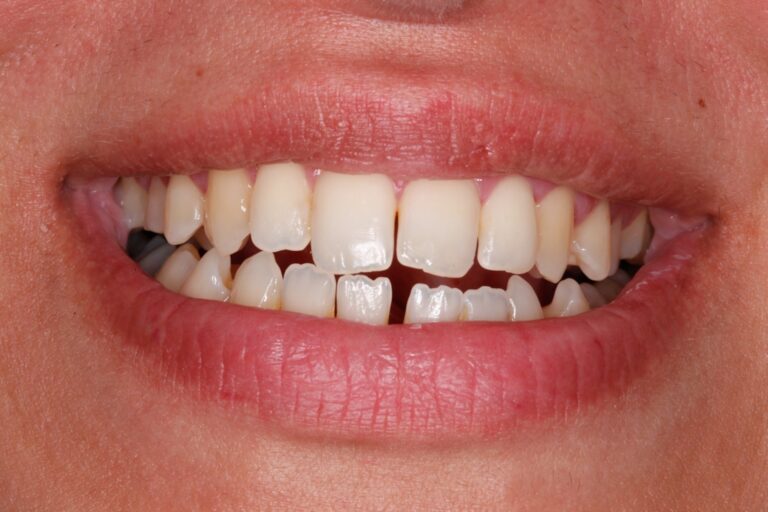 Patient's bite before orthodontic treatment (example 16)