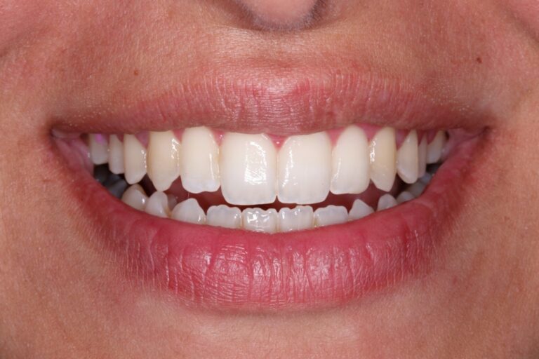 Patient's bite after clear aligner treatment (example 16)