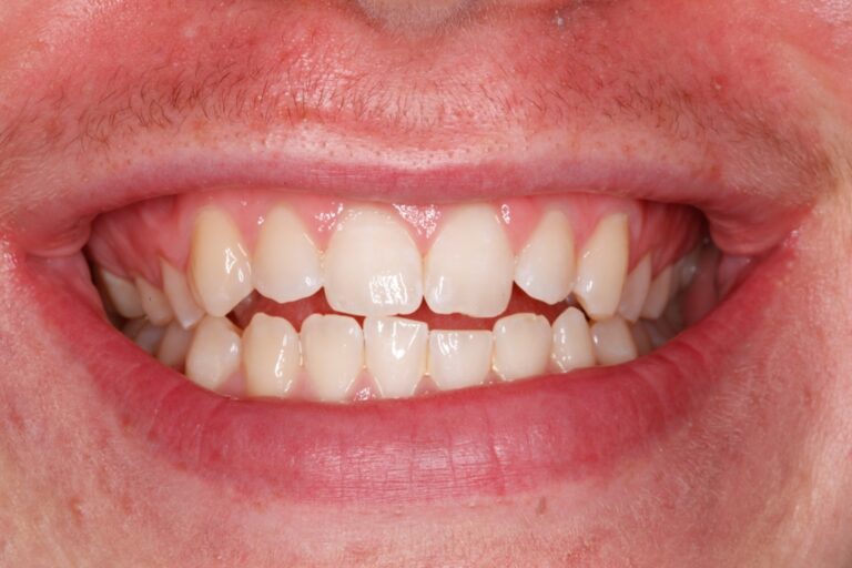 Patient's bite before orthodontic treatment (example 17)