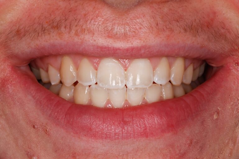Patient's bite after clear aligner treatment (example 17)