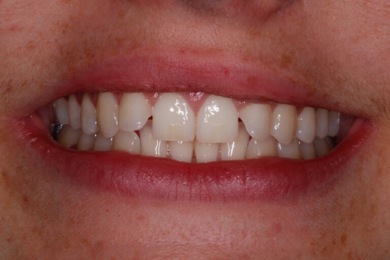 Patient's bite before orthodontic treatment (example 18)