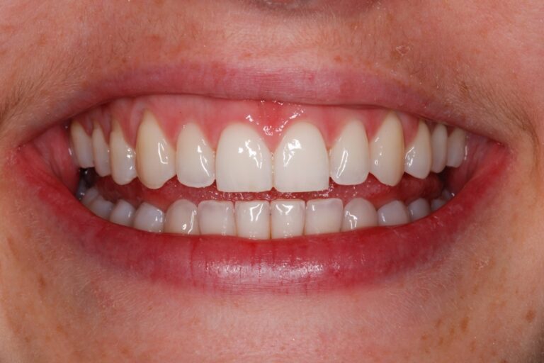 Patient's bite after clear aligner treatment (example 18)