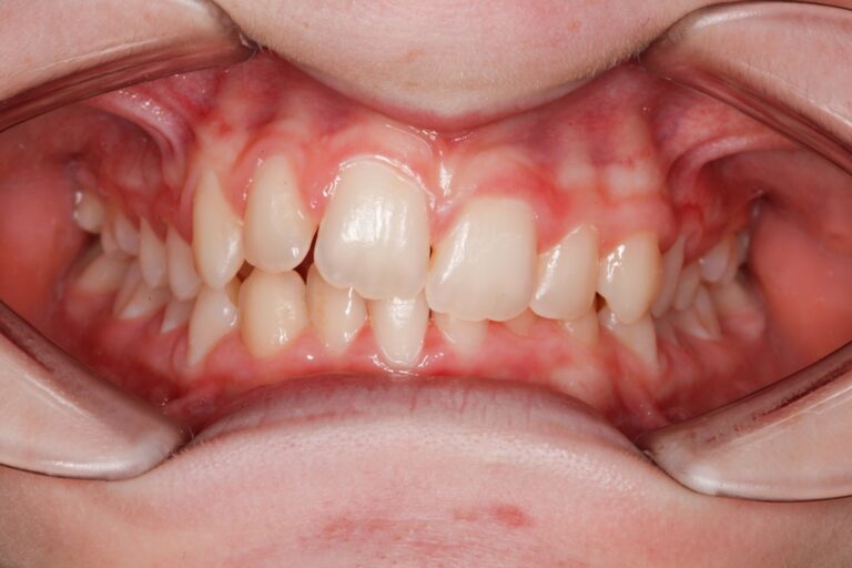 Patient's bite before orthodontic treatment (example 19)