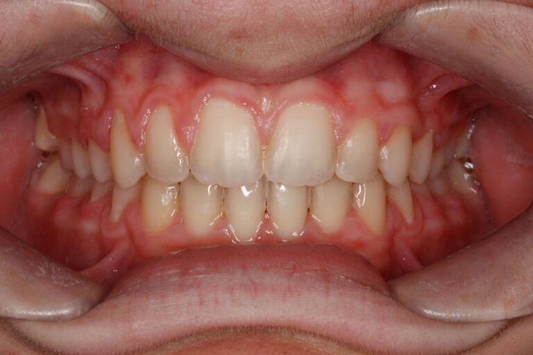 Patient's bite after clear aligner treatment (example 19)