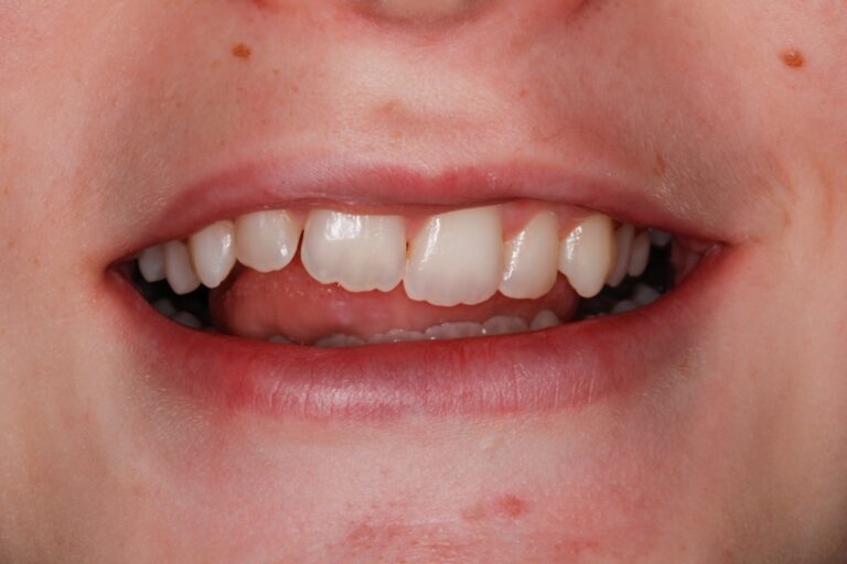 Patient's bite before orthodontic treatment (example 20)