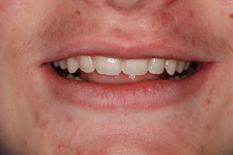 Patient's bite after clear aligner treatment (example 20)