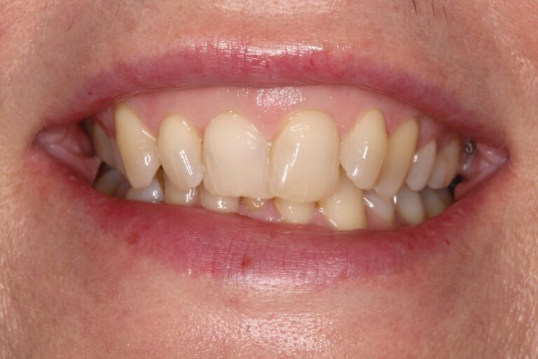 Patient's bite before orthodontic treatment (example 21)