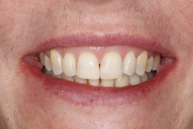 Patient's bite after clear aligner treatment (example 21)