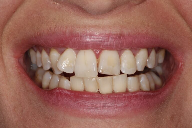 Patient's bite before orthodontic treatment (example 22)