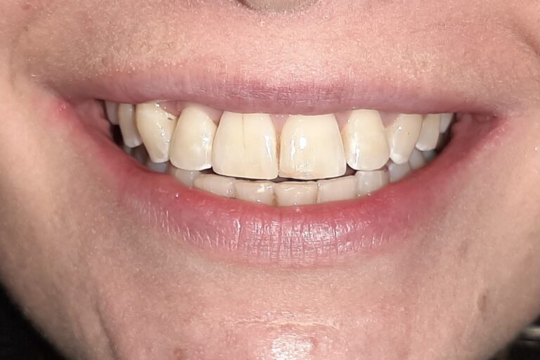 Patient's bite after clear aligner treatment (example 22)