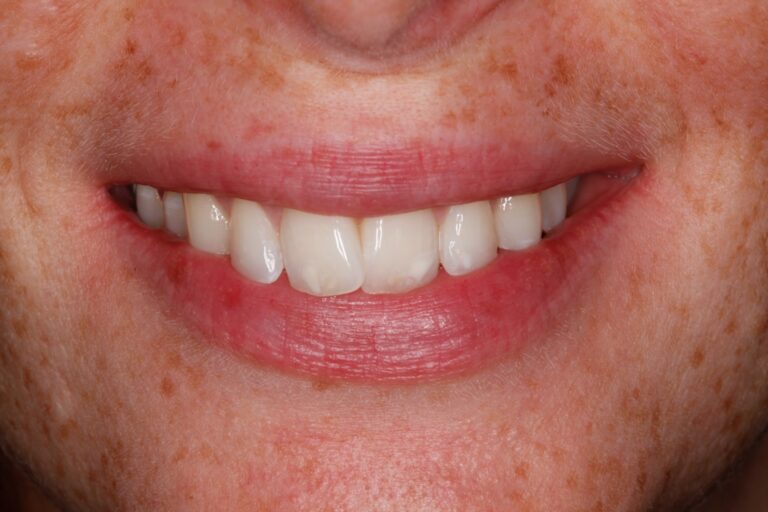 Patient's bite before orthodontic treatment (example 23)