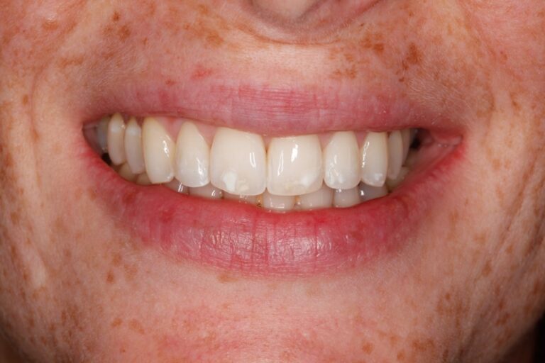Patient's bite after clear aligner treatment (example 23)