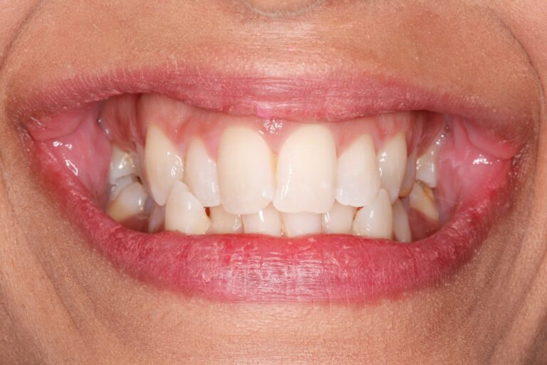 Patient's bite before orthodontic treatment (example 24)