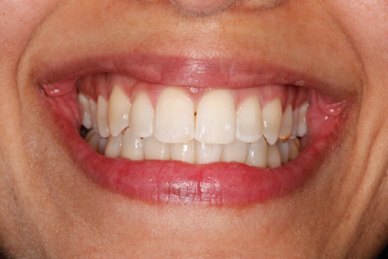 Patient's bite after clear aligner treatment (example 24)
