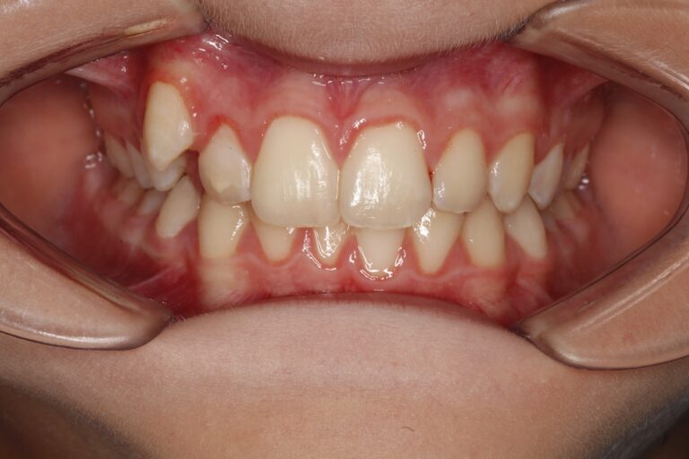 Patient's bite before orthodontic treatment (example 25)