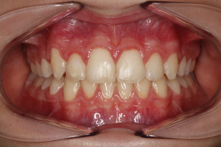 Patient's bite after clear aligner treatment (example 25)