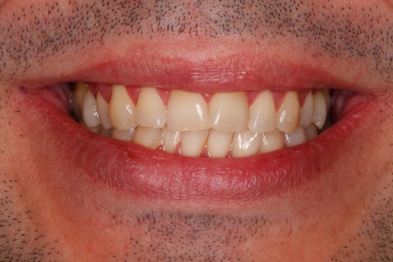 Patient's bite before orthodontic treatment (example 26)