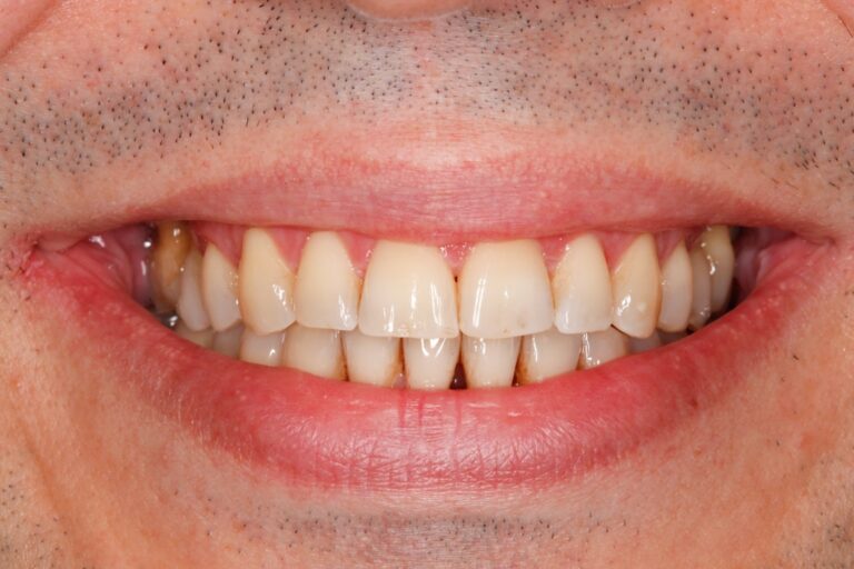 Patient's bite after clear aligner treatment (example 26)