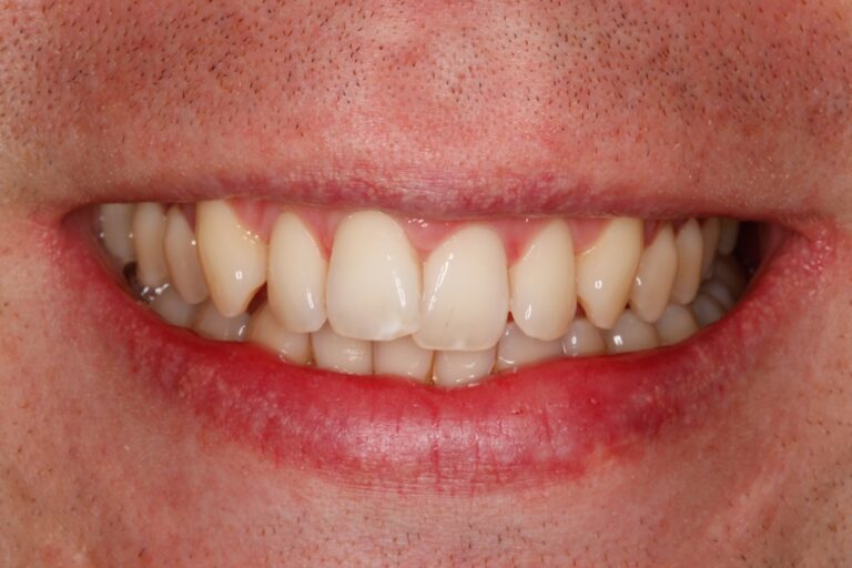 Patient's bite before orthodontic treatment (example 27)