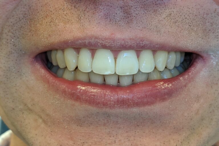Patient's bite after clear aligner treatment (example 27)