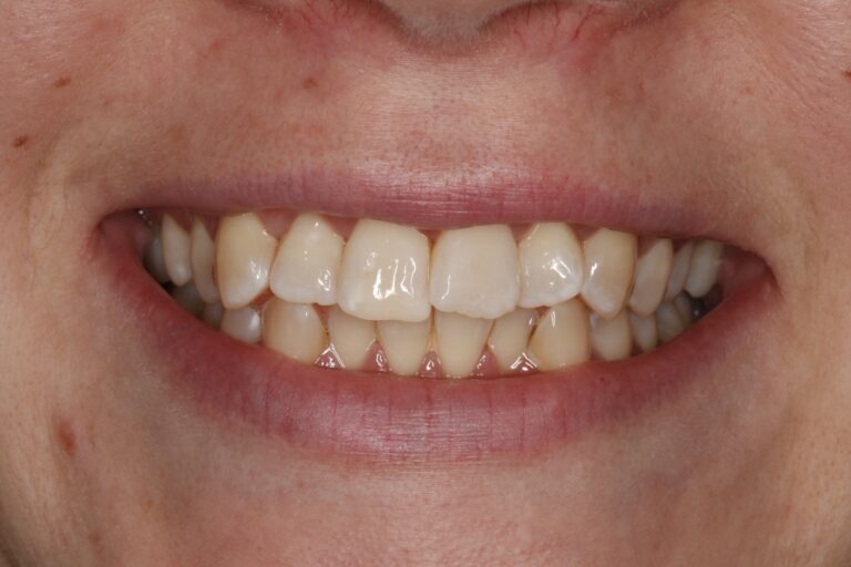 Patient's bite before orthodontic treatment (example 28)