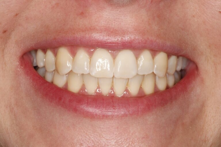 Patient's bite after clear aligner treatment (example 28)