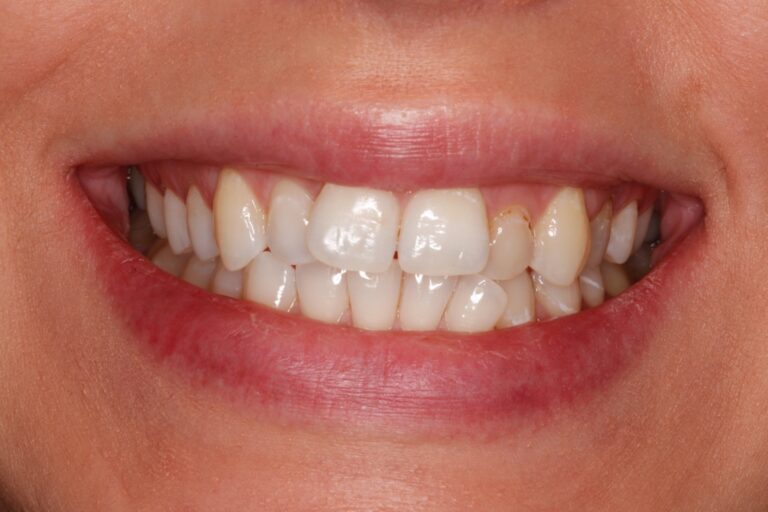 Patient's bite before orthodontic treatment (example 29)