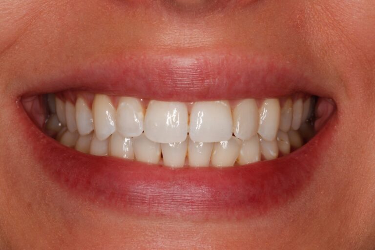 Patient's bite after clear aligner treatment (example 29)