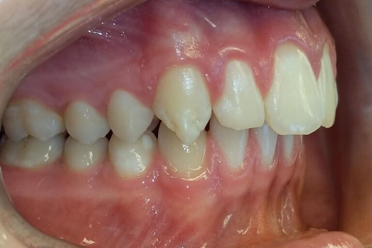 Patient's bite before orthodontic treatment (example 30)
