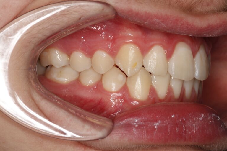 Patient's bite after clear aligner treatment (example 30)