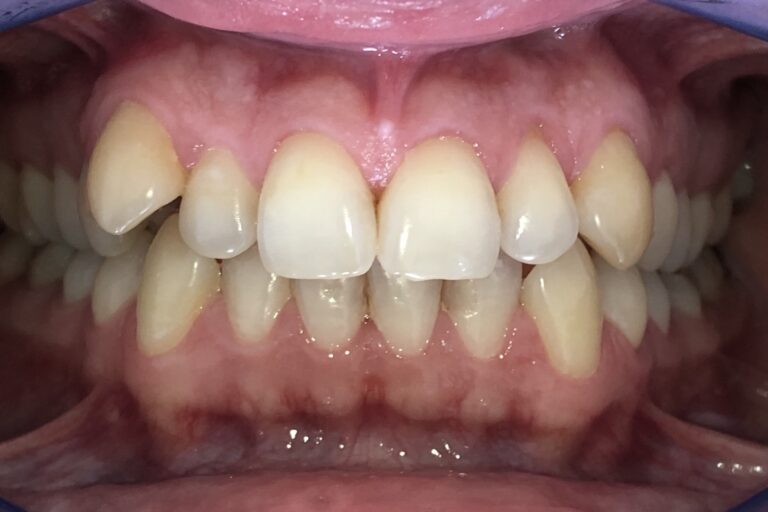 Patient's bite before orthodontic treatment (example 31)