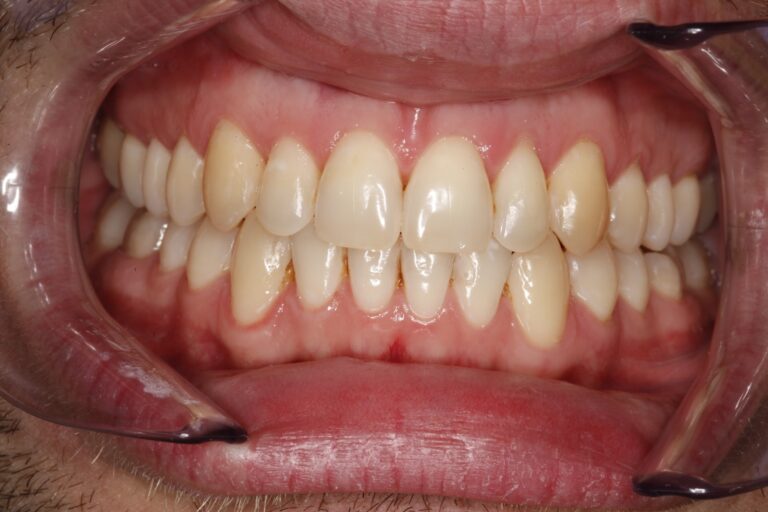 Patient's bite after clear aligner treatment (example 31)