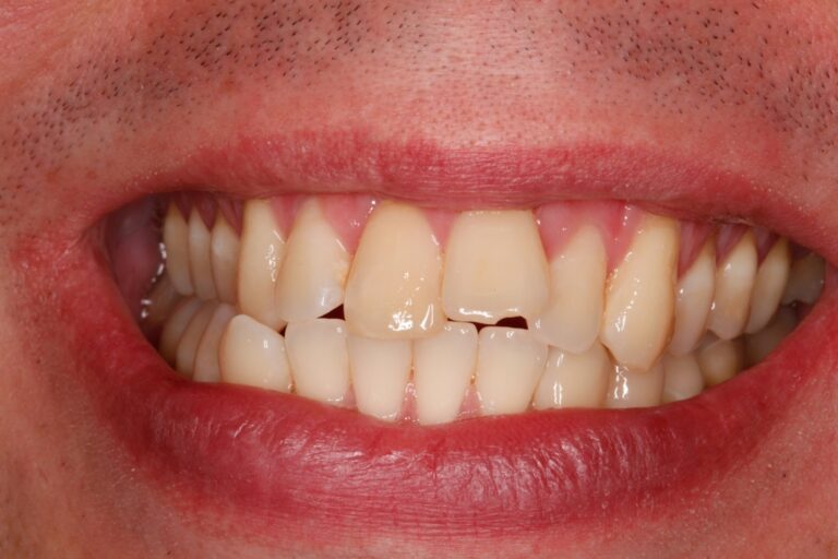Patient's bite before orthodontic treatment (example 32)