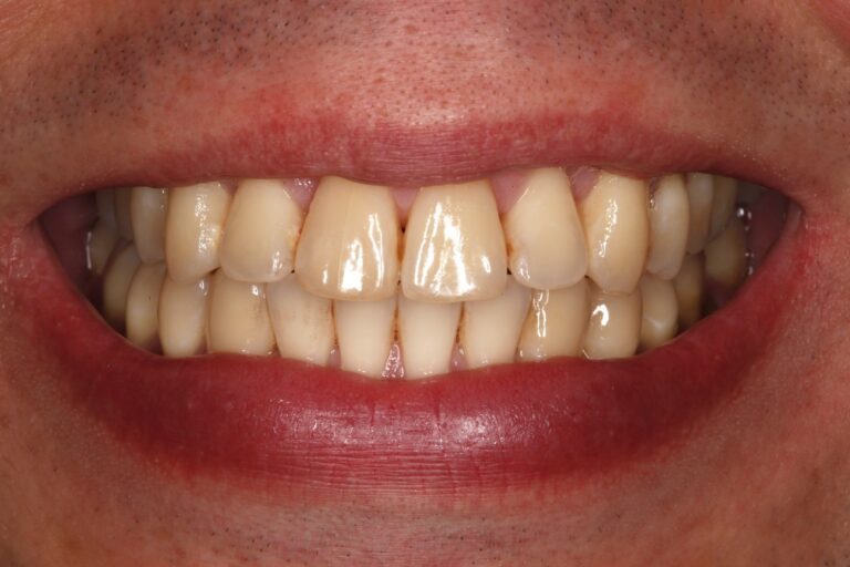 Patient's bite after clear aligner treatment (example 32)