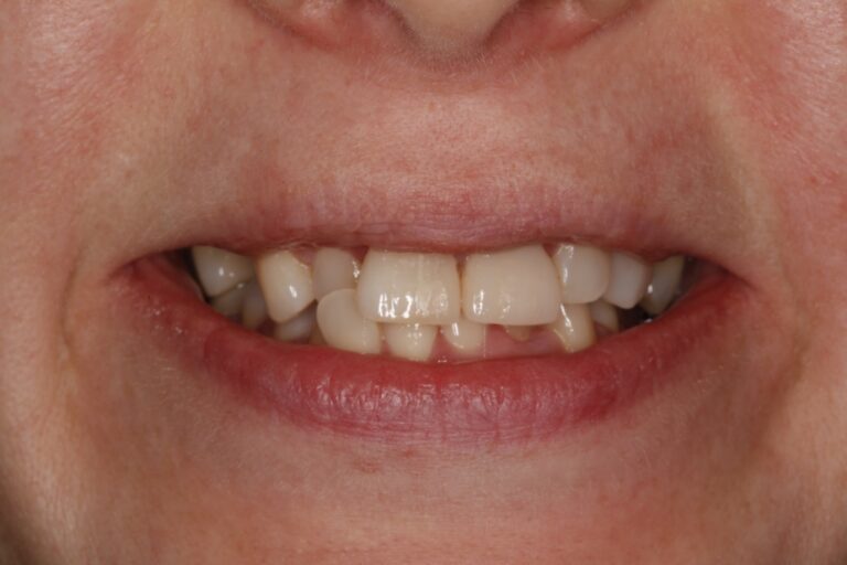 Patient's bite before orthodontic treatment (example 33)