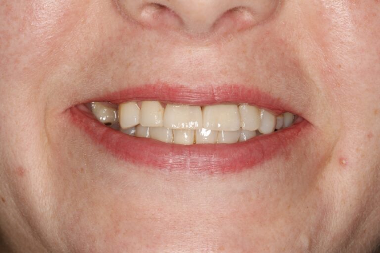Patient's bite after clear aligner treatment (example 33)