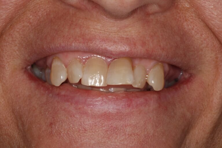 Patient's bite before orthodontic treatment (example 34)