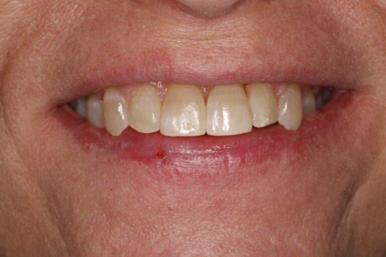 Patient's bite after clear aligner treatment (example 34)